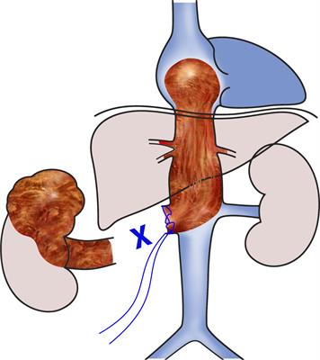 Renal cell carcinoma with intracardiac tumor thrombus extension: Radical surgery yields 2 years of postoperative survival in a single-center study over a period of 30 years
